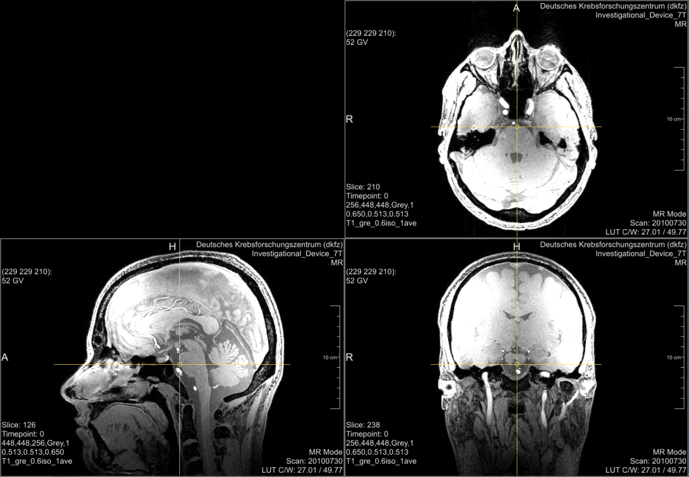 Figure 1. Example for a magnetic resonance head image (MRI). The upper MRI shows an original layer of data set of an study participant (axial view, parallel to the feet). The MRIs below are reconstructions of the original data in sagittal view (left) and coronal view (right). The sagittal view is similar to a head silhouette and therefore more familiar.
