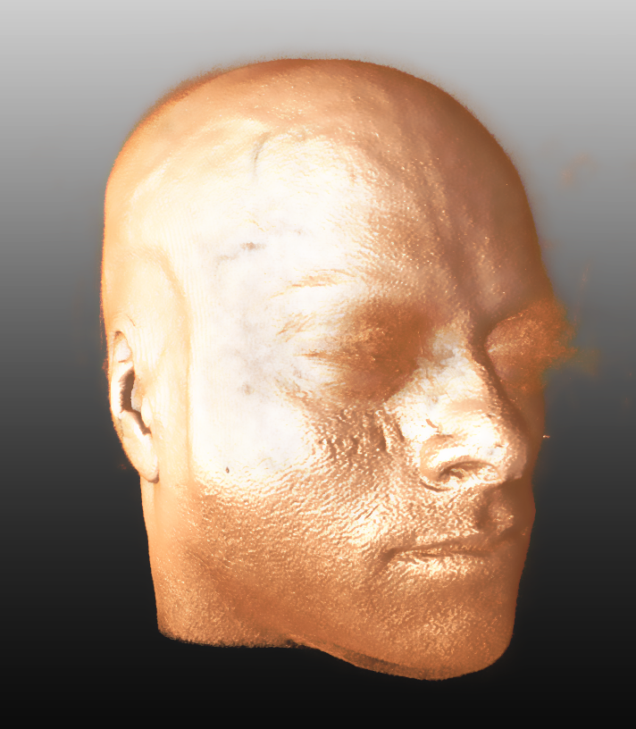 Figure 2. Volumetric rendering of the data set shown in Figure 1. The possibility to reidentify is now strikingly obvious. Volumetric rendering can easily be done with software tools publically available.